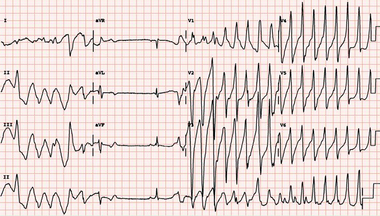 2. VT duration/ haemodynamic consequence Nonsustained VT < 30 s Sustained VT >