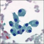 Oncocytic Neoplasms Oncocytoma Oncocytoma
