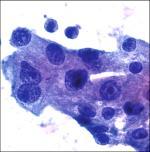 cytology => carcinoma Oncocytic CA Oncocytic CA