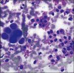 Malignant Mixed Tumors 1. Carcinoma ex pleomorphic adenoma (rare) CA arising out of pleomorphic adenoma 2.