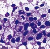 adenomas, CAs Acinic cell CA Mucoepidermoid