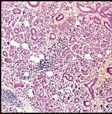 inflamed tumor WARD cells Chronic Sialadenitis Diffusely enlarged firm gland (oft submandibular) Can form firm nodule, ~ neoplasm (Küttner