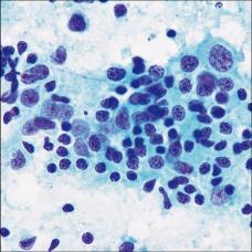 Lymphoepithelial Sialadenitis Marked lymphoid infiltrate Lymphoepithelial