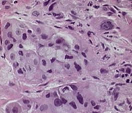 variant *Image from www.surgical-pathology.com; Image from http://www.lmp.ualberta.ca/resources/pathoimages/pc-s.
