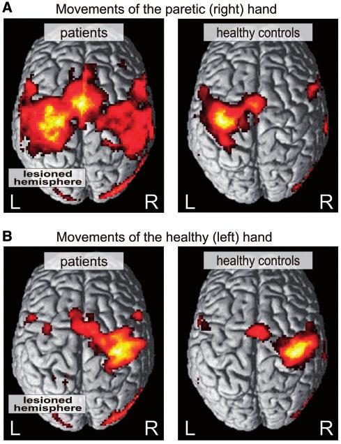 Reorganization of cerebral networks after stroke Brain 2011: 134; 1264 1276 1265 connectivity in stroke patients to demonstrate changes in functional interactions after stroke that relate to clinical