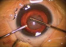 cataract Surgery in first 4-8