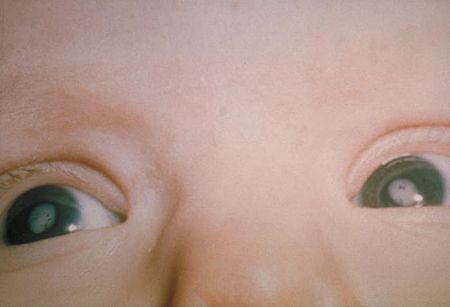 A newborn infant presents with bilateral white cataracts.