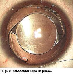 size normal No other significant associated ocular abnormalities Good lens