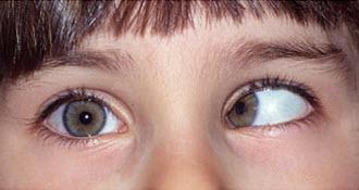 Strabismus Lens implant does not prevent development of strabismus Percent of patients developing strabismus over time increases 24.6% (baseline) to 70.