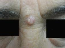 DERMCASE Test your knowledge with Test your multiple-choice knowledge cases with multiple-choice cases This month 6 cases: 1. A Lesion between the Eyes p.29 2. Perianal Papules p.32 3.