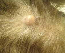 Case 5 A Lump on the Scalp A 90-year-old female was advised by her hairdresser to see her physician about a lump on her scalp.