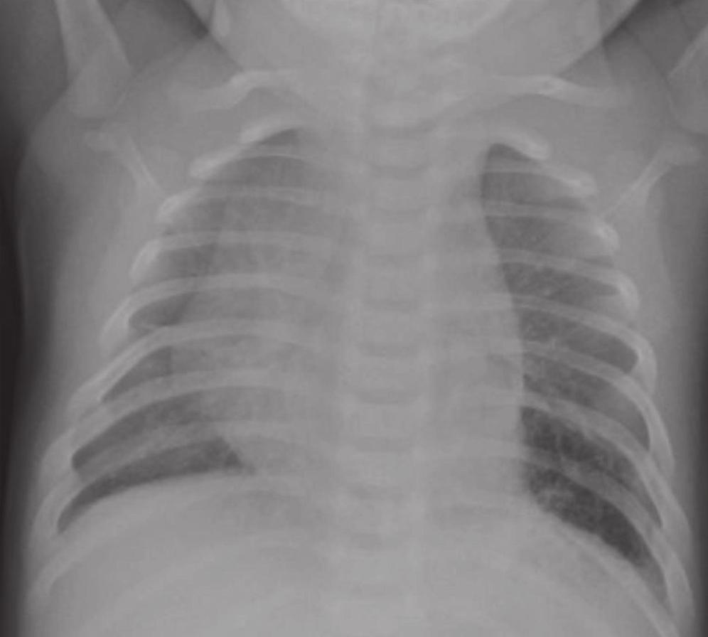 24. An infant with recurrent pneumonia underwent a frontal chest radiograph (Fig 24-A) followed by