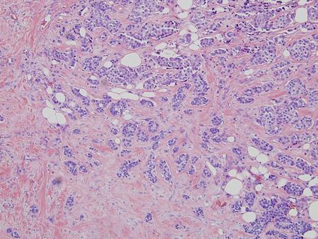 25 Histology: breast cancer; nests of malignant