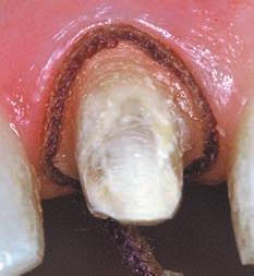 5 Options 1. If a tooth has 2 or more large composite restorations consider a full crown.
