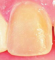 4. Keep tooth reductions uniform. area commonly under prepared Even with experienced operators, the tendency is to remove insufficient facial enamel in the area shown.