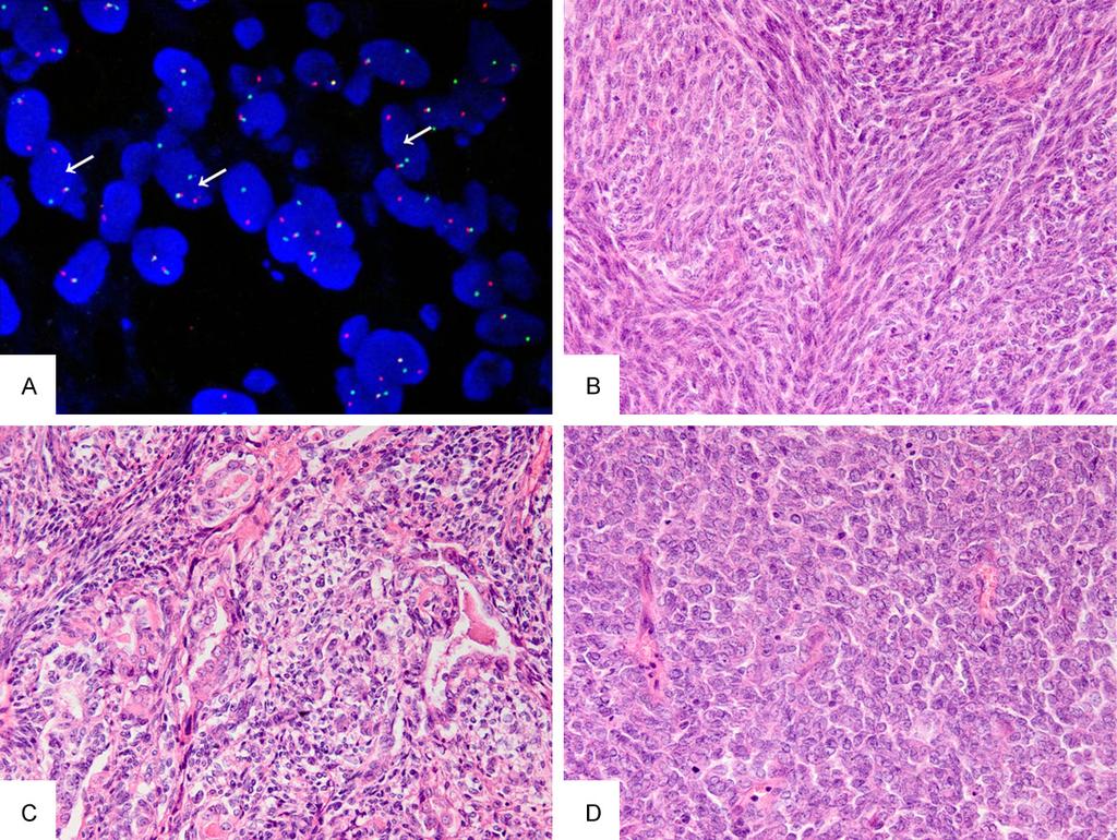 Figure 1. Histological types of genetically confirmed synovial sarcomas. A. Detection of SS18 rearrangement by FISH.
