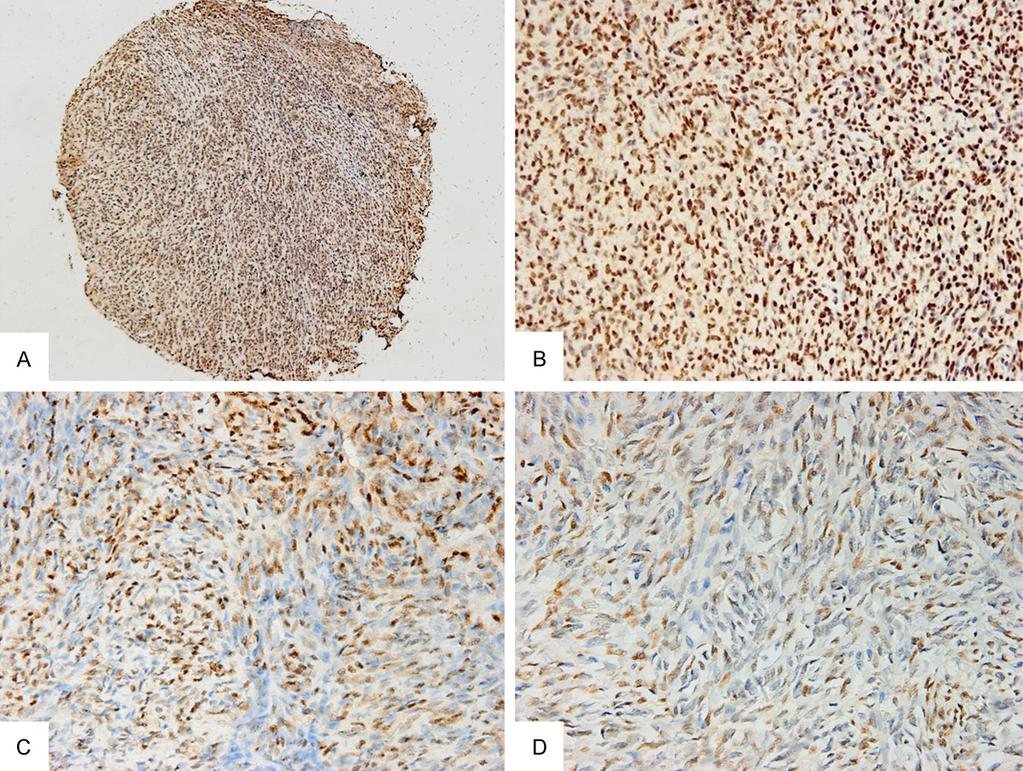Figure 2. TLE1 immunohistochemical staining results in synovial sarcomas. A. Synovial sarcoma with 3+ TLE1 expression (original magnification 100 ). B. Synovial sarcoma with 3+ TLE1 expression. C.