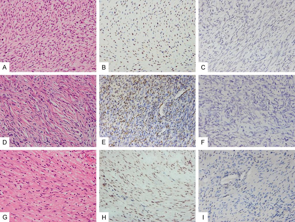 Figure 3. TLE1 immunohistochemical staining results for nonsynovial sarcomas. A. Myxoid area in a MPNST. B. MPNST with 2+ TLE1 expression. C. TLE1 negativity in a MPNSTs. D.