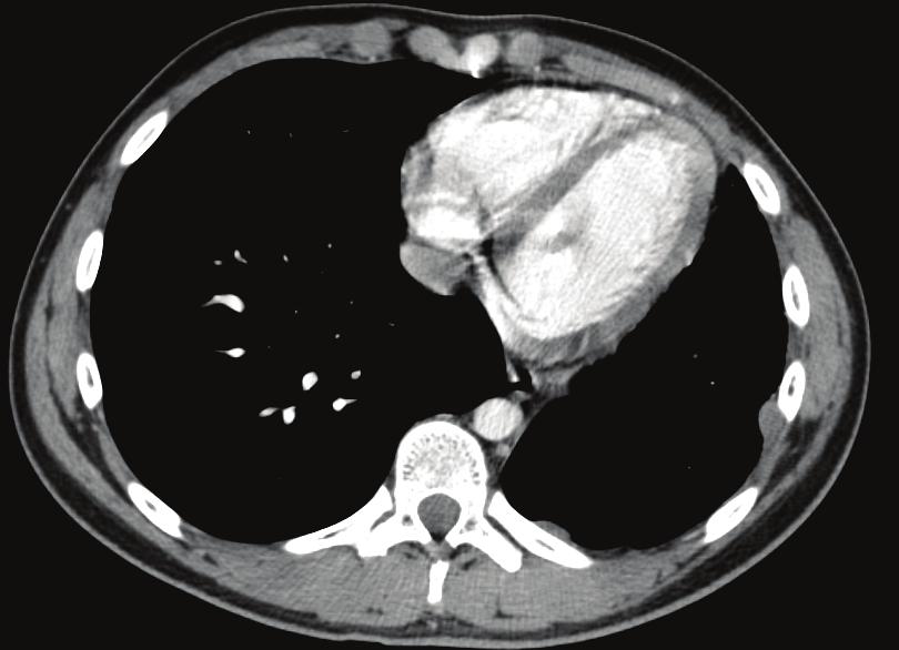 the right, the blue arrows indicate the subpleural multiple nodules, histologically proven).