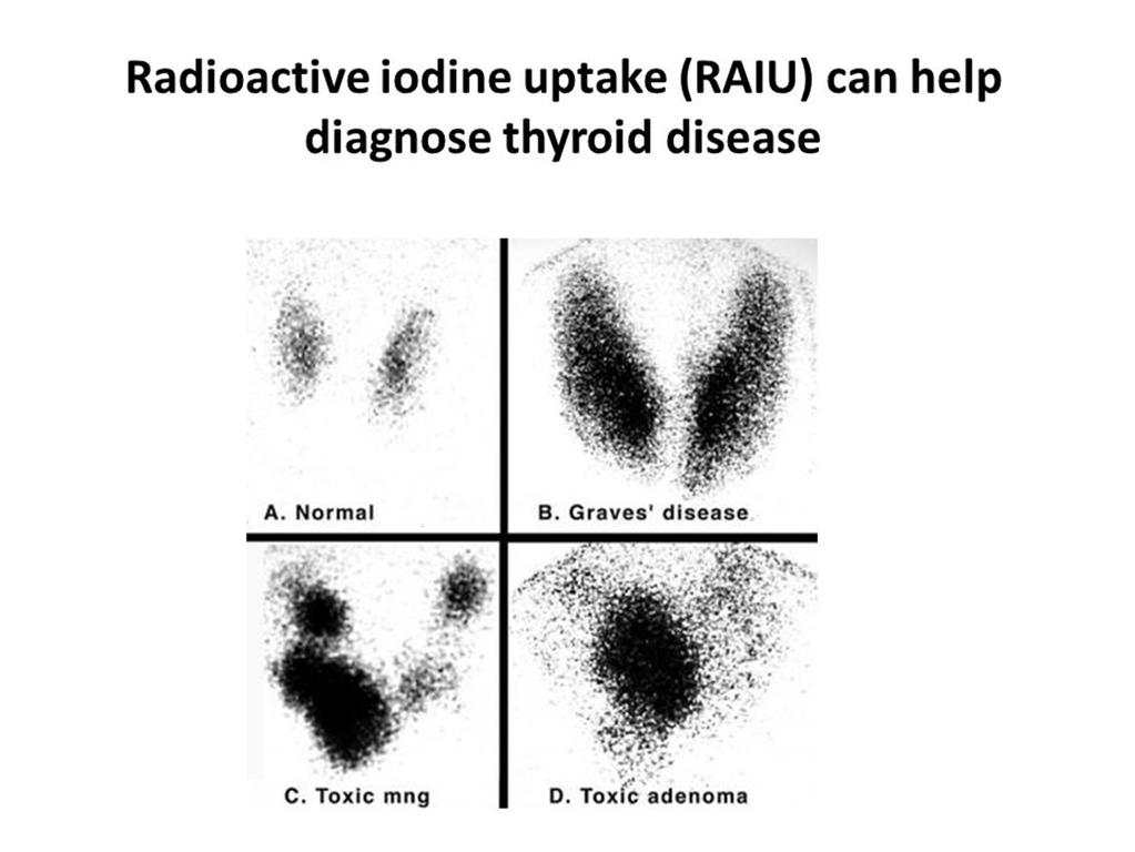 DDx: 24 hour RAIU High RAIU (>20%) Low RAIU (<5%) Graves disease Toxic MNG Solitary toxic