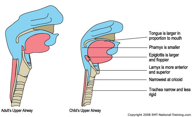 Anatomical Differences As a result - Airway Due to epiglottis, straight blade is more useful Larger occiput increases neck flexion Large, floppy epiglottis Larger tongue relative to size of