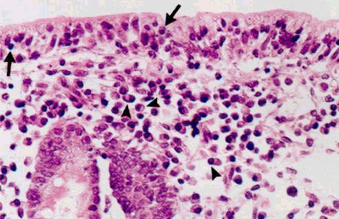 Marked increase in intraepithelial lymphocytes (arrows) in duodenal surface