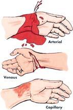 local protocol) Place part in plastic bag Hemorrhage External bleeding Arterial Venous Capillary Hemorrhage