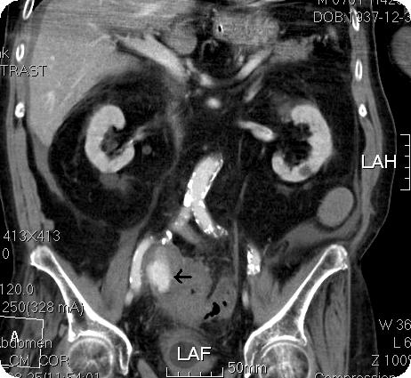 Embolization of ruptured iliac aneurysm emergency department (ED) due to abdominal pain. He underwent anterior resection for rectal cancer several years ago. His abdomen was severely distended.