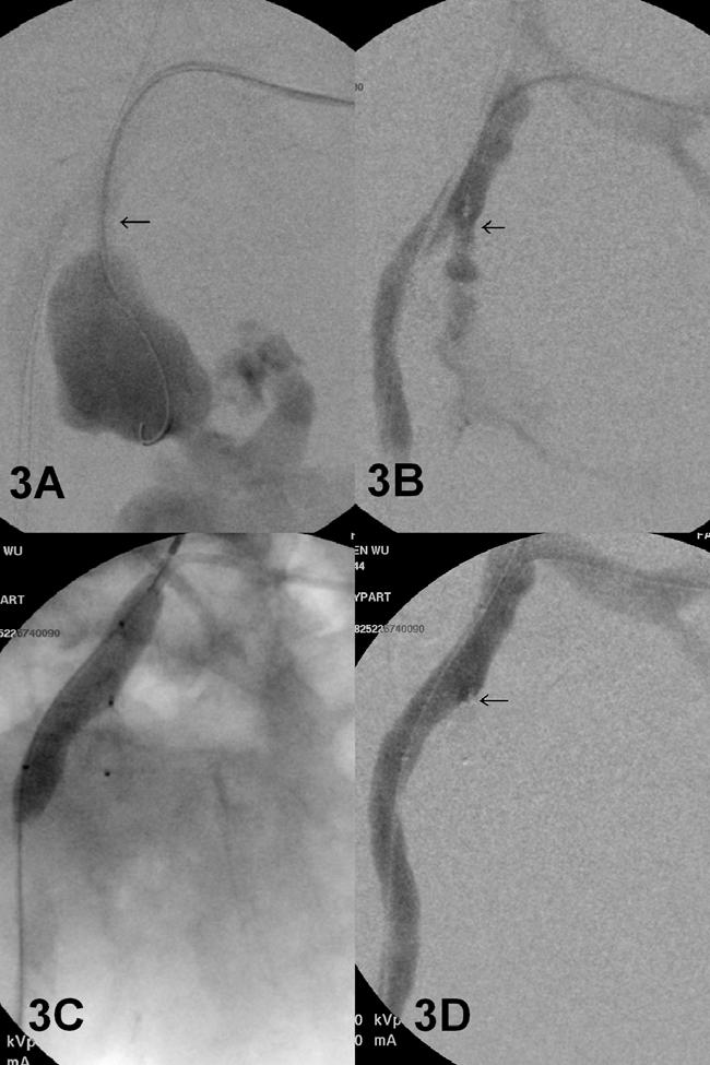 Jer-Shen Chen et al. However, because of the accumulated retroperitoneal hematoma, his abdomen remained severely distended.