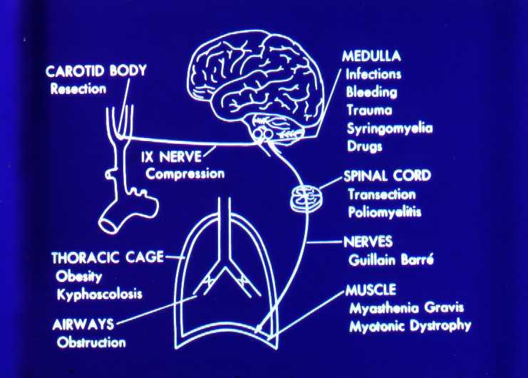Hypoventilation Won t breathe resp drive Brainstem stroke Sedatives Can t breathe NM