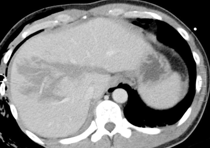 Case Progression Patient electively intubated Two intravenous lines placed and patient received 40 ml/kg normal saline CT