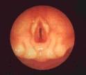 dysfunction/edema) Tracheal stenosis Tracheostomy Hemorrhage Infection