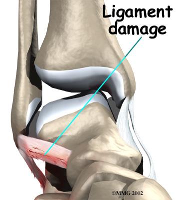 This type of injury is sometimes called a high ankle sprain because it involves the ligaments above the ankle joint.