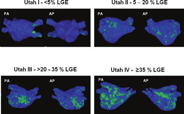 Vergara and Marrouche Tailored Management of Atrial Fibrillation with LGE-MRI 3 Figure 2. University of Utah Atrial Fibrillation LGE-MRI-based staging system.