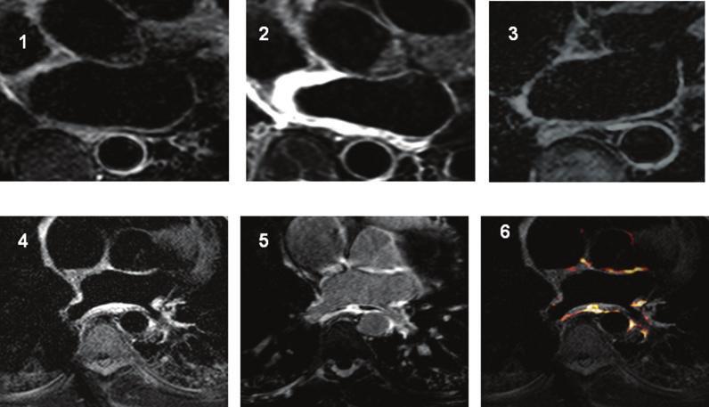 Vergara and Marrouche Tailored Management of Atrial Fibrillation with LGE-MRI 5 Figure 5. Postablation edema and scar distribution, temporal extension, and resolution.