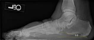 Plantar Fasciitis Mechanical overload altered load Micro tears Degeneration of collagen Uncommon to see traumatic rupture Imaging features Edema in the