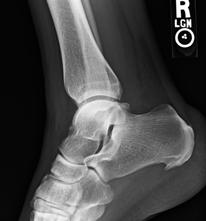 25% in asymptomatic patients Calcaneal Enthesopathy Remember inflammatory arthritis Reactive http://pubs.rsna.org/doi/figure/10.1148/radiol.