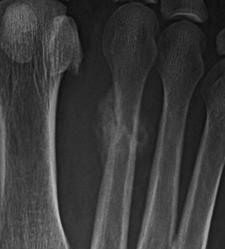 restraint to ankle inversion Injury as patient moves into plantar