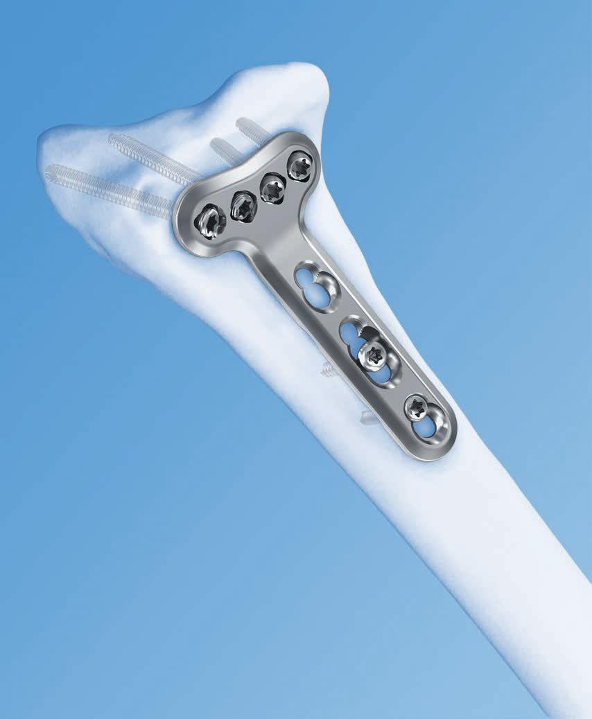2.4 mm Variable Angle LCP Volar Extra-Articular Distal Radius System.