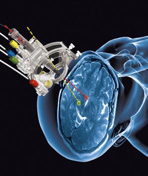 About Deep Brain Stimulation What is deep brain stimulation (DBS)? Deep brain stimulation is a surgical treatment using electrical stimulation of specific brain areas.