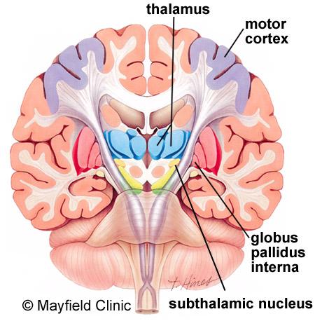 Electrodes can be placed in the following brain areas (Fig 2): Subthalamic nucleus (STN) effective for tremor, slowness, rigidity, dystonia and dyskinesia.