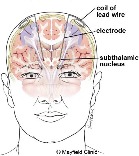 You will lie on the table and the stereotactic head frame will be secured. This prevents any small movements of your head while inserting the electrodes. You will remain awake during surgery.