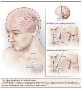 Parkinson s Disease DBS What are the common brain targets?