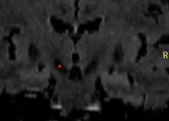 Candidates for DBS Significant fluctuating motor symptoms or wearing off not responsive to medications. Significant asymmetry of PD motor signs. Severe medication refraction tremor or dystonia.