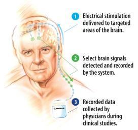 Several research groups are working on brain radios that not only stimulate, but