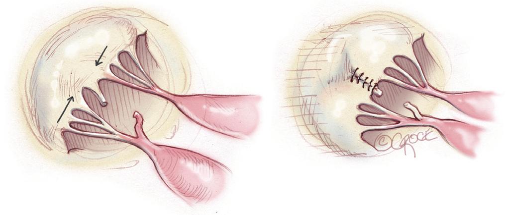 (A), the placement of sutures to pleat the untethered segment; (B), pleating of segment caused by a ruptured chordae tendinae; (C), completion of valvuloplasty; (D), completion of the valvuloplasty.