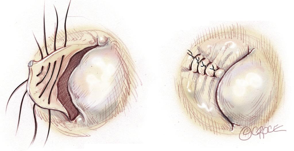 Standard length annuloplasty is based upon the principle that dilatation of the mitral annulus in degenerative disease primarily occurs posteriorly, and that reduction to a standard size supports