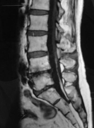 the location of the fatty filum were evaluated on MRI. And disc degeneration was also evaluated in 7 patients according to DeCandido's classification (4).