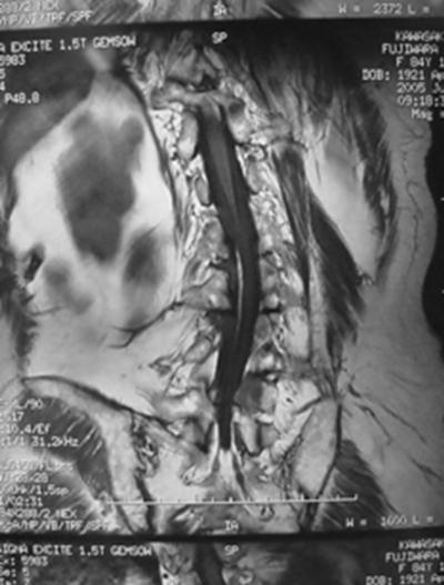 Figure 7 Figure 8 CASE 2. FEMALE 84 Y.O. ; PERSISTENT LOW BACK PAIN She complained persistent low back pain.