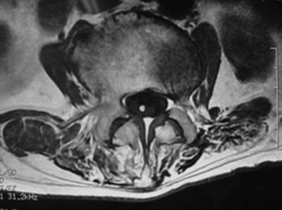 MRI showed a strand (L2-S, 15mm away from conus medullaris, Φ2mm) on T1 coronal view in lumbar thecal sac (Fig3.a). The diameter was 2mm.